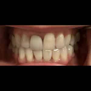 Before Image: Incrustation (Onlay)