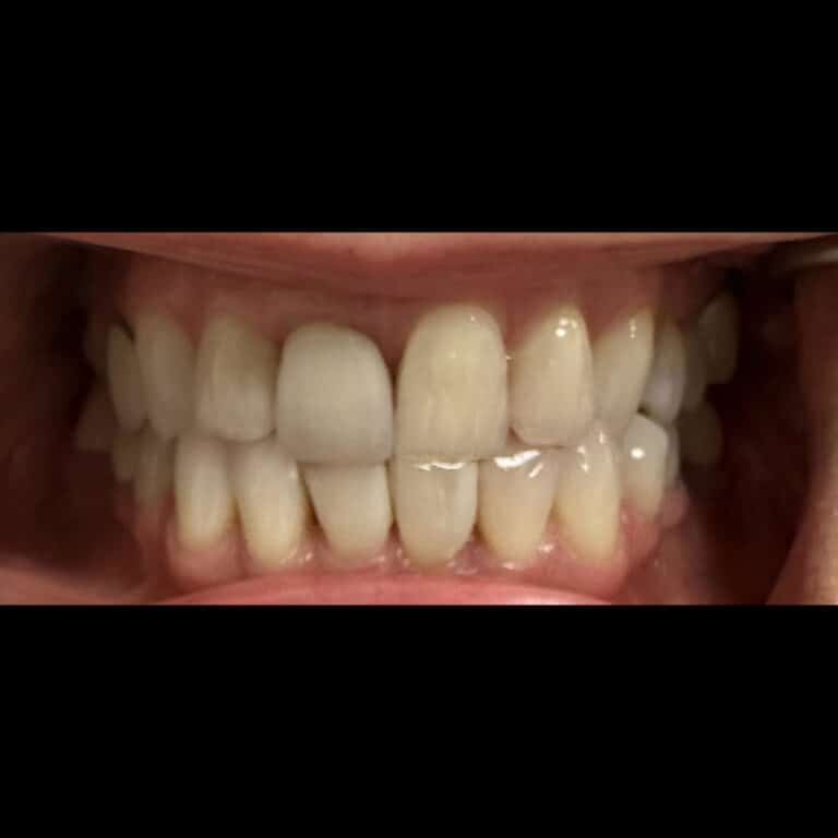 Before Image: Incrustation (Onlay) - front