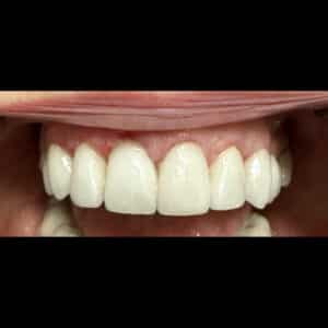 After Image: Incrustation (Onlay)