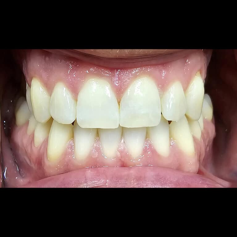 After Image: Blanchiment des Dents - front