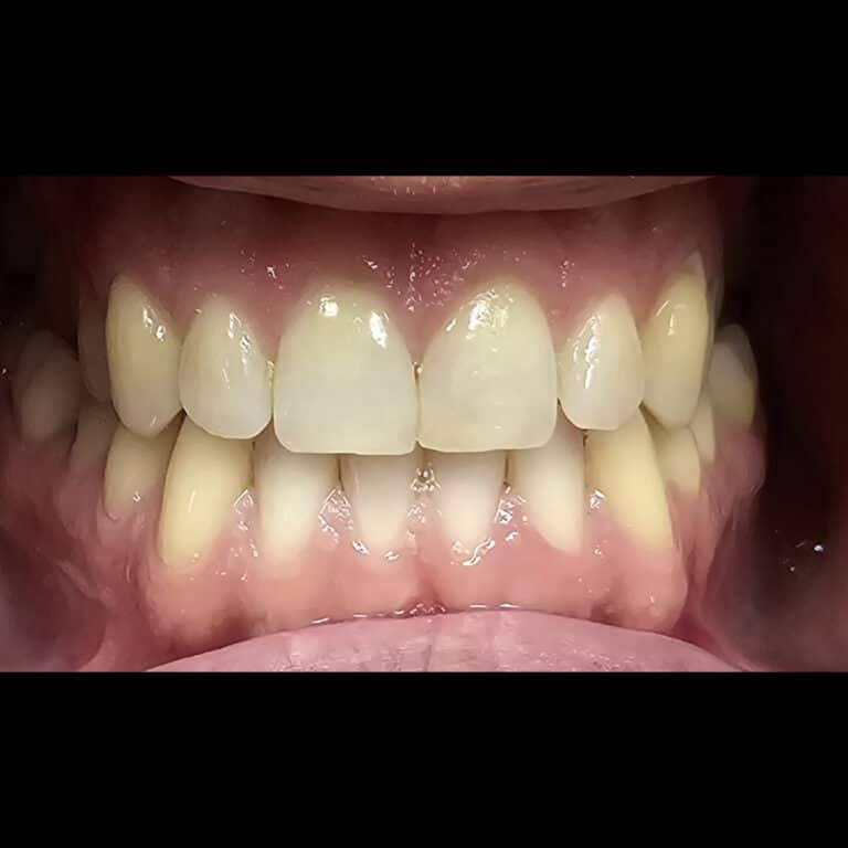 Before Image: Blanchiment des Dents - front