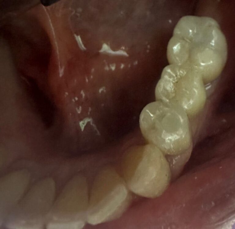 After Image: Pont retenu par des implants - front