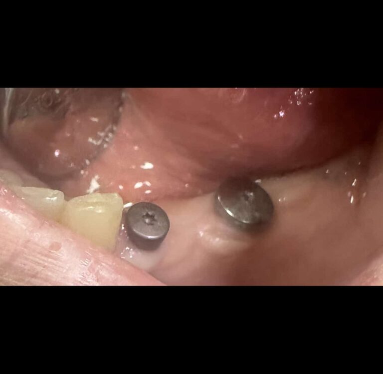 Before Image: Pont retenu par des implants - front