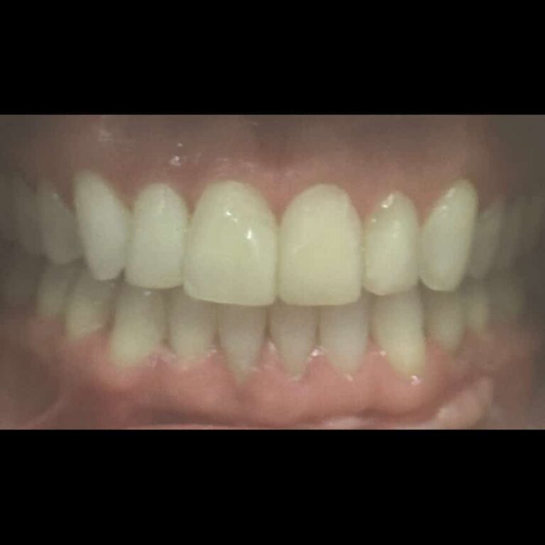 After Image: Invisalign - front