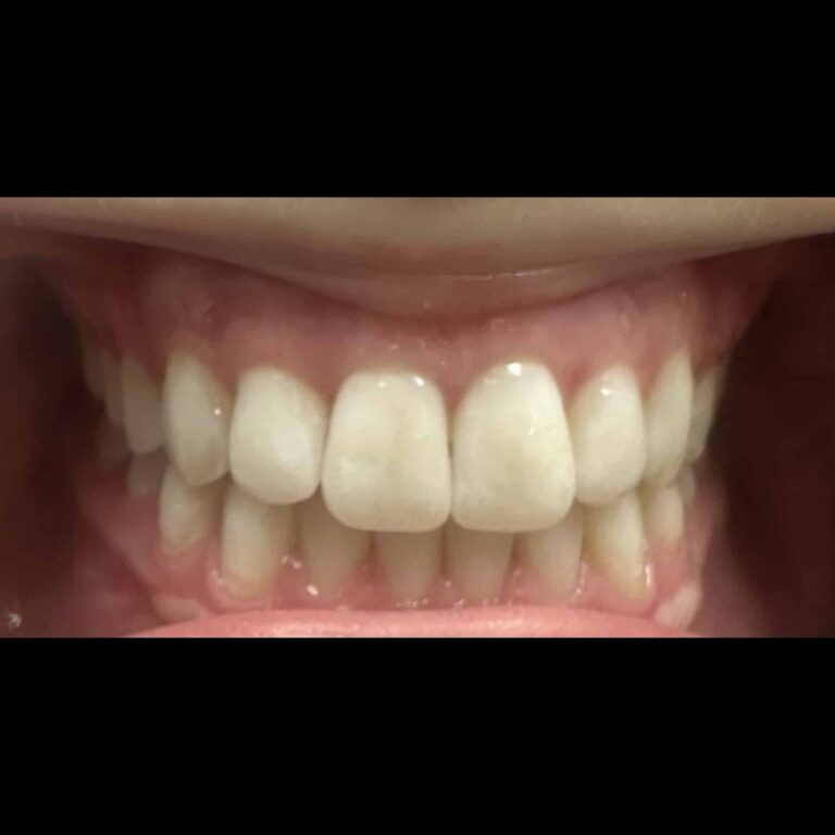 After Image: Blanchiment des Dents - front