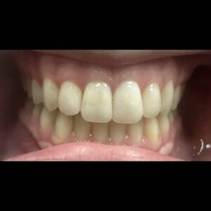 Before Image: Blanchiment des Dents
