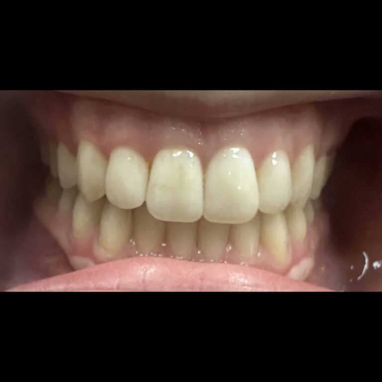 Before Image: Blanchiment des Dents - front