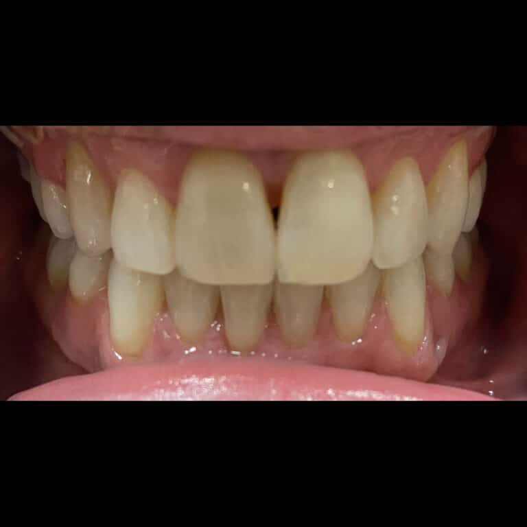 After Image: Invisalign - front