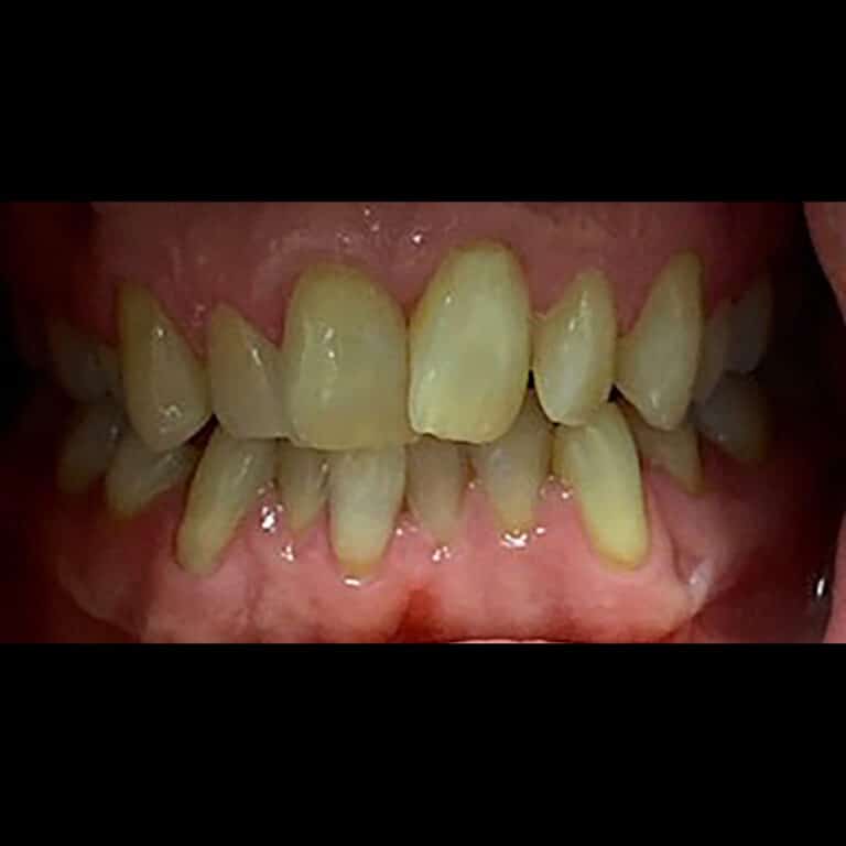 Before Image: Invisalign - front