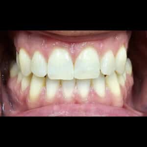 After Image: Teeth Whitening