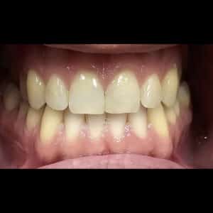 Before Image: Teeth Whitening