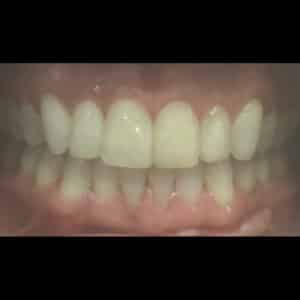 After Image: Invisalign