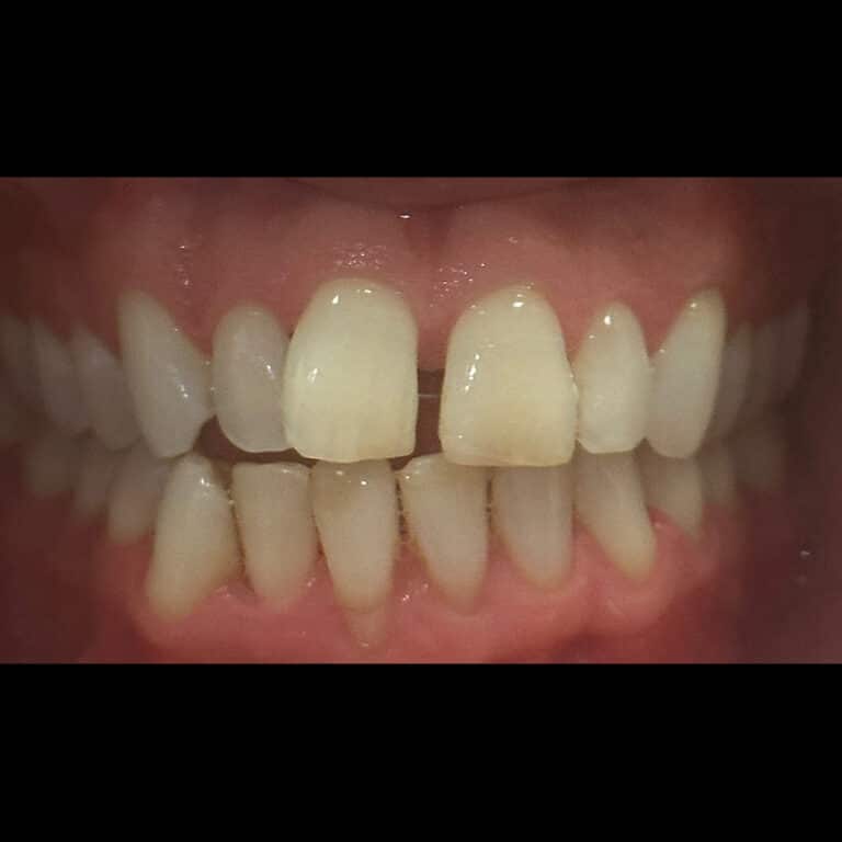 Before Image: Invisalign - front