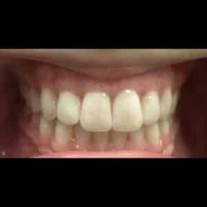 After Image: Teeth Whitening