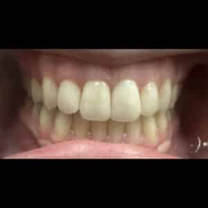 Before Image: Teeth Whitening