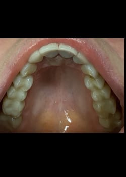 After Image: Filling with composite resin or (White fillings) - front