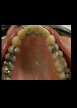 Before Image: Filling with composite resin or (White fillings) - front