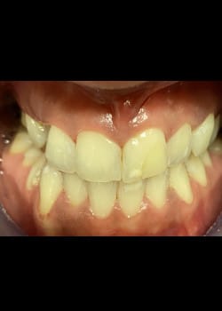 Before Image: Teeth Whitening - front