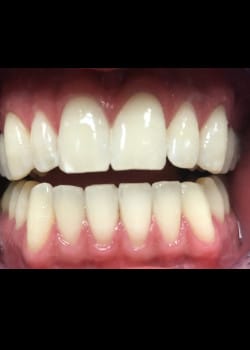 After Image: Teeth Whitening - front