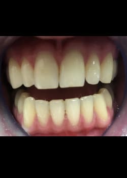 Before Image: Teeth Whitening - front