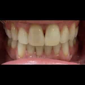 After Image: Invisalign