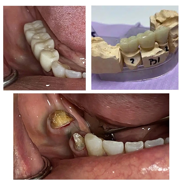 Dental Bridges