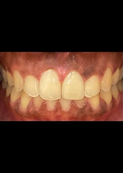 After Image: Invisalign & Facettes en acylique - other