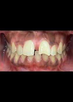 Before Image: Invisalign & Facettes en acylique - other